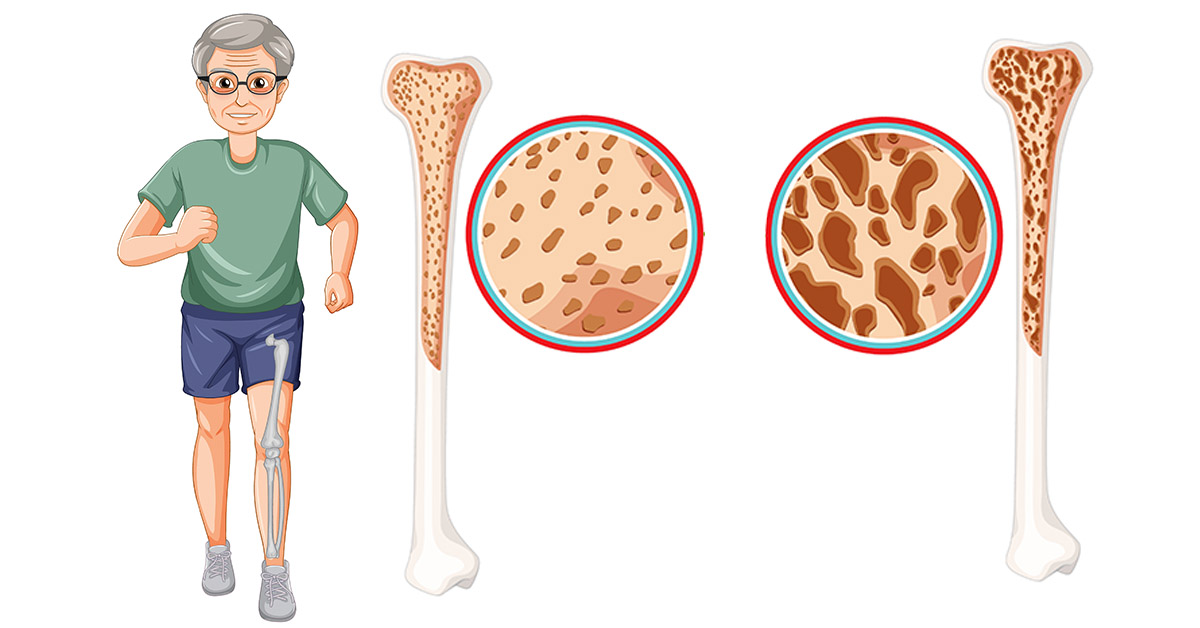 osteoporose-em-homens-ricardo-favero-junior-jpg.jpg